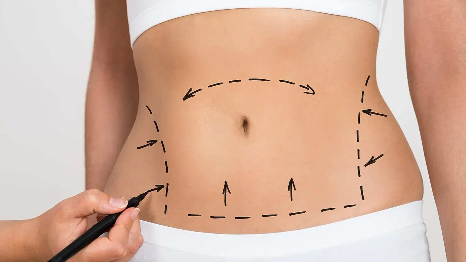 Marked stomach for cosmetic surgery planning.