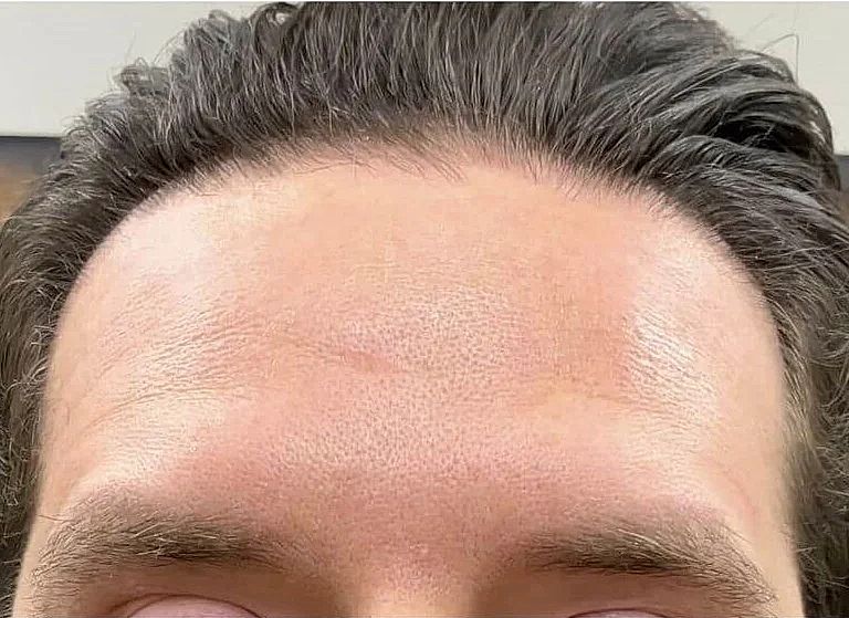 Botox  Before & After