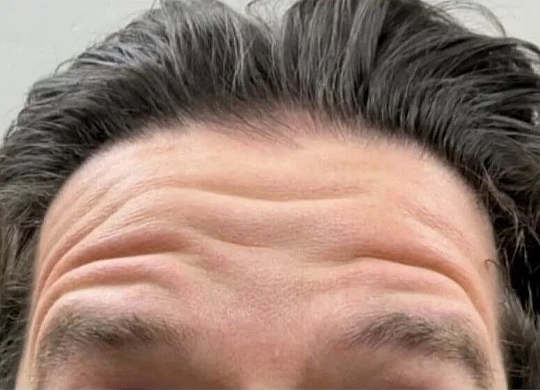 Botox  Before & After