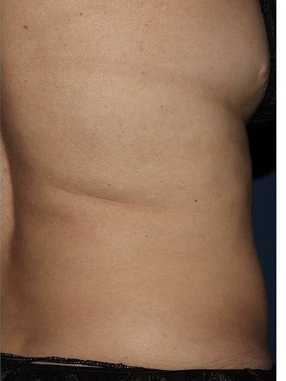CoolSculpting® Before & After