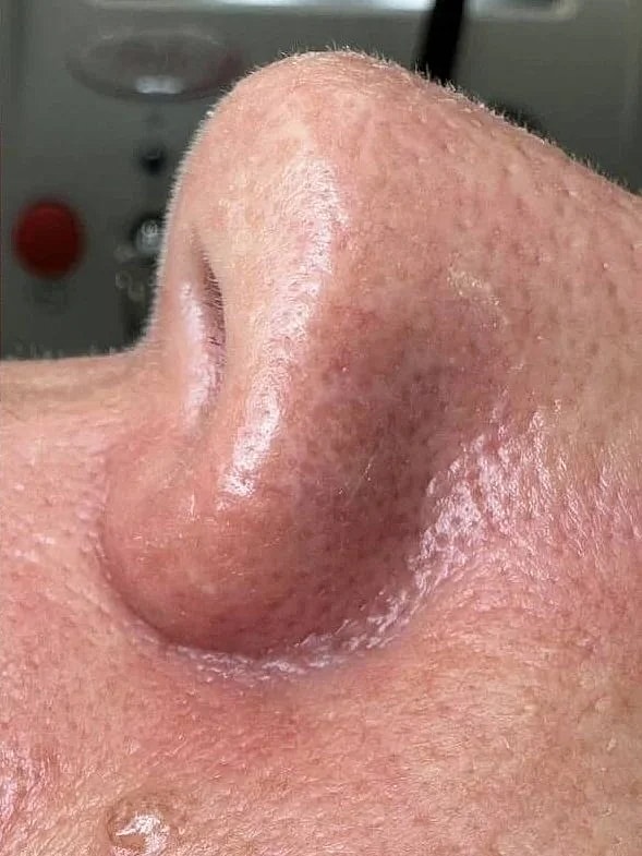 Laser Skin Resurfacing Before & After