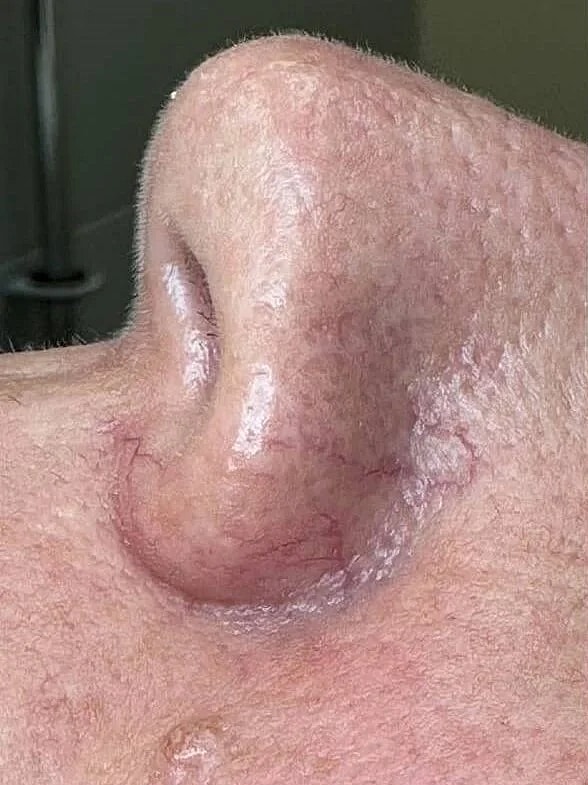 Laser Skin Resurfacing Before & After