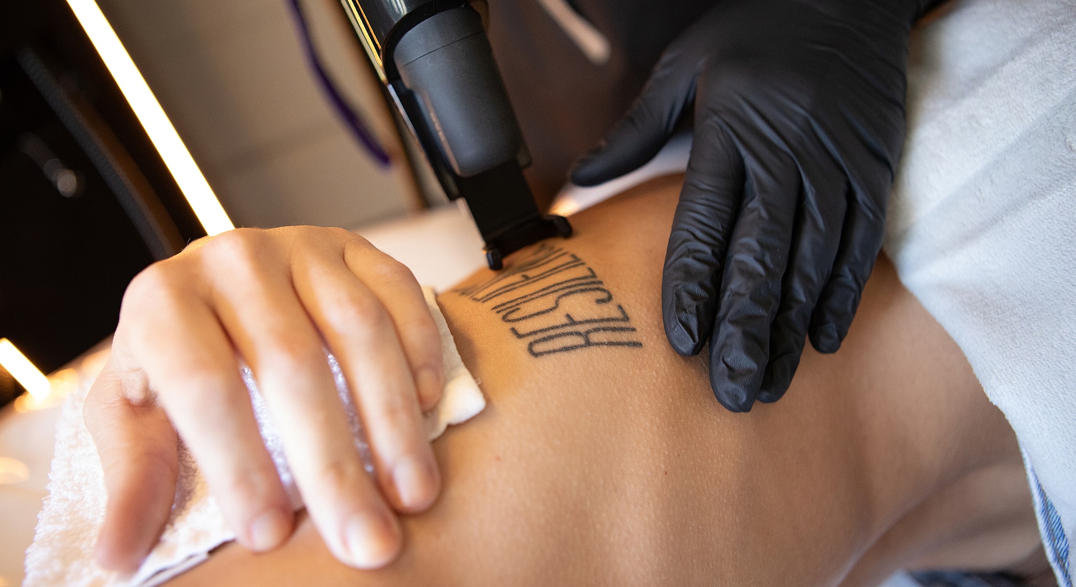 Tattoo removal process in progress on skin.