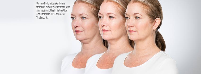 Photo of women with a progress result of her KYBELLA treatment